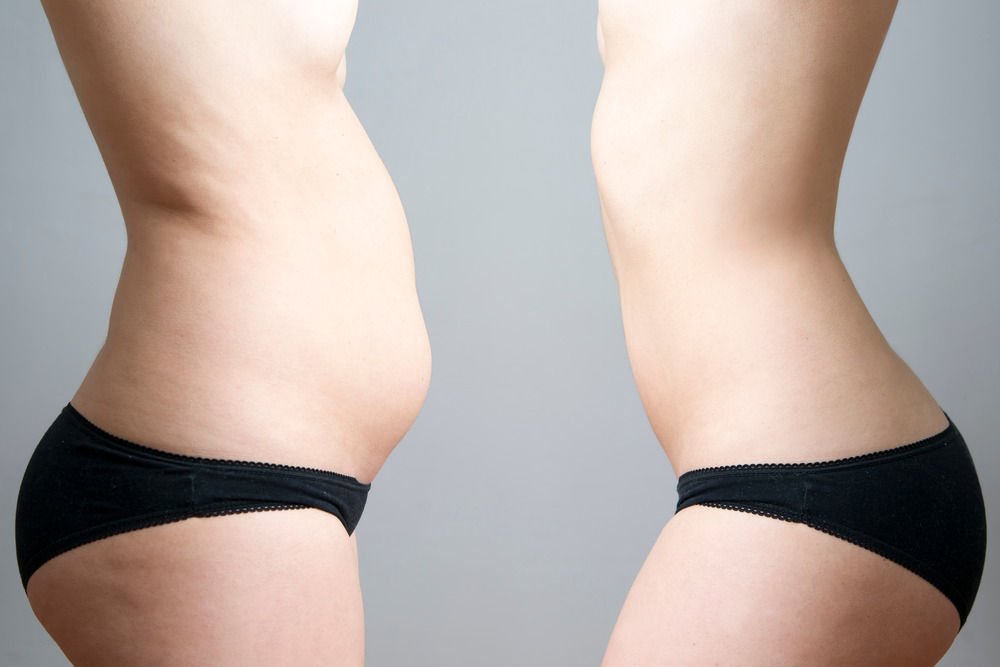 A patient before and after liposuction surgery to remove a pocket of fat