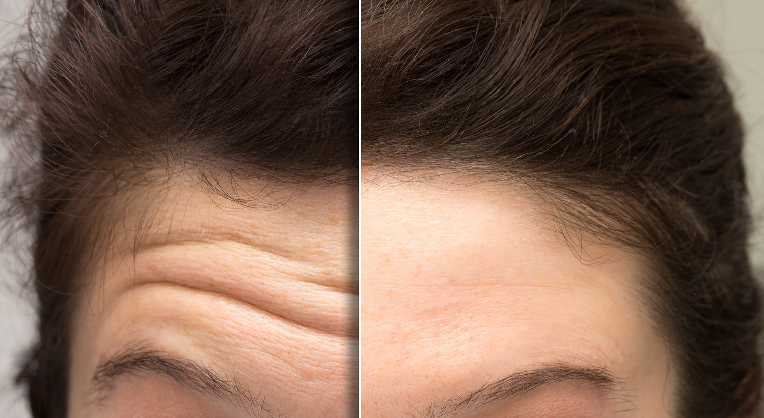 A split view of a woman's forehead before and after a brow lift